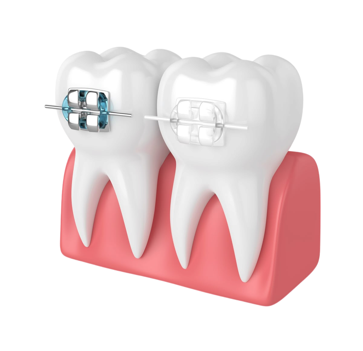 Braces and Aligners treatment in Kochi