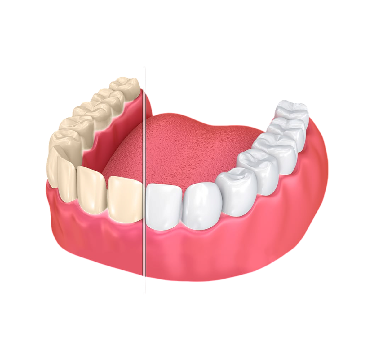 Teeth Whitening in Kochi